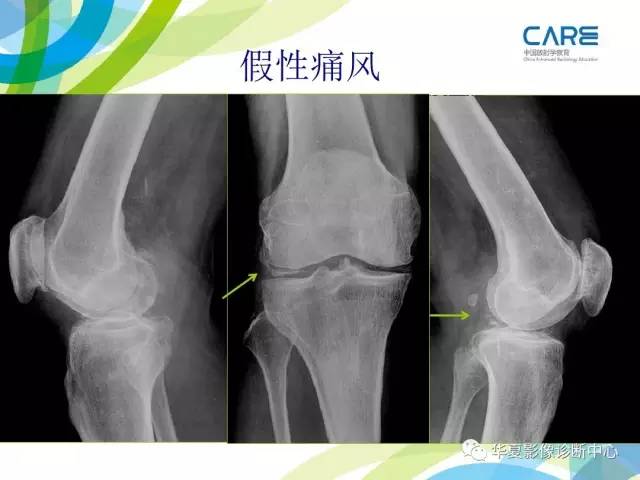【PPT】骨肌系统影像学基本征象再认识