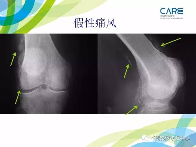 【PPT】骨肌系统影像学基本征象再认识