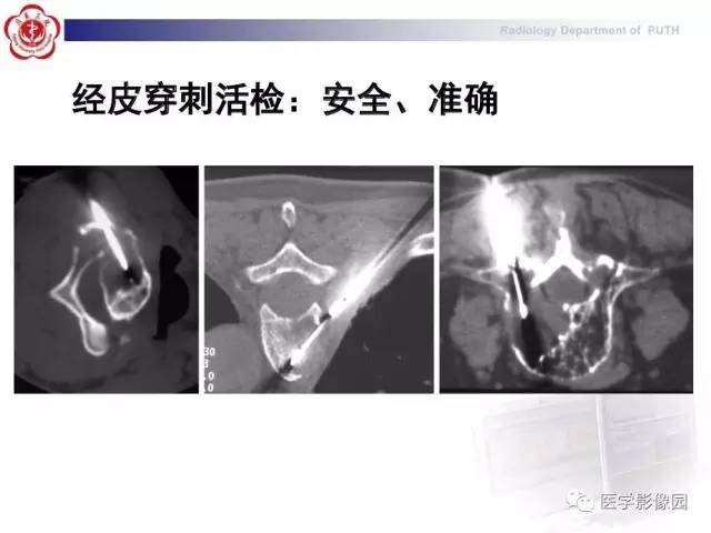 【PPT】脊柱肿瘤影像诊断思路