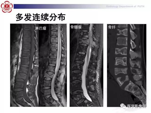 【PPT】脊柱肿瘤影像诊断思路