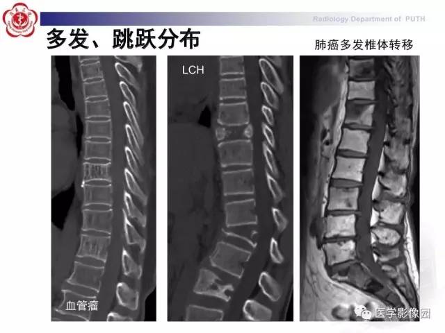 【PPT】脊柱肿瘤影像诊断思路