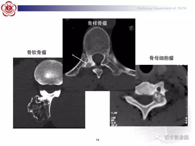 【PPT】脊柱肿瘤影像诊断思路