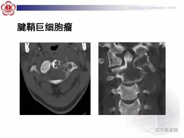 【PPT】脊柱肿瘤影像诊断思路