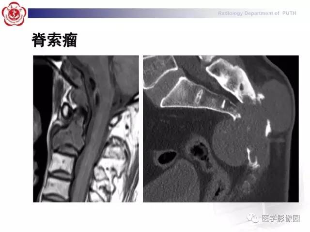 【PPT】脊柱肿瘤影像诊断思路