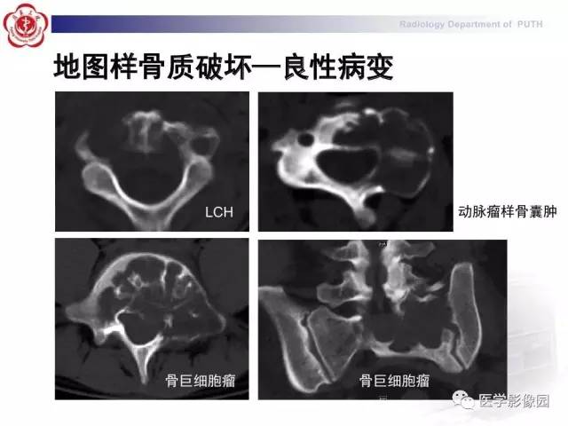 【PPT】脊柱肿瘤影像诊断思路
