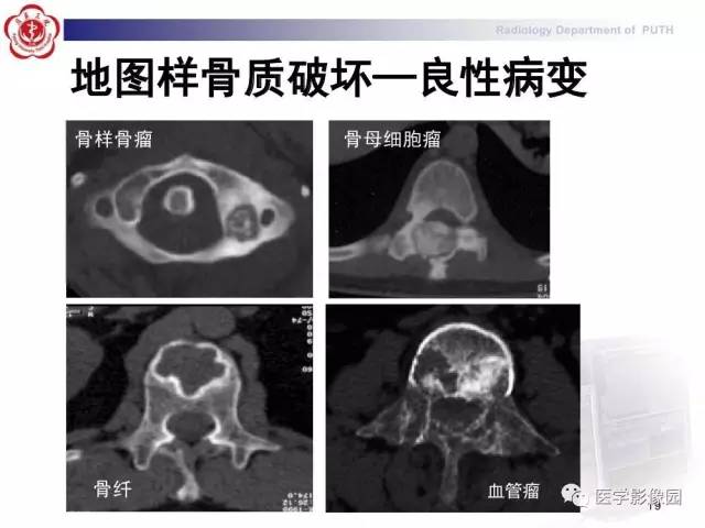 【PPT】脊柱肿瘤影像诊断思路