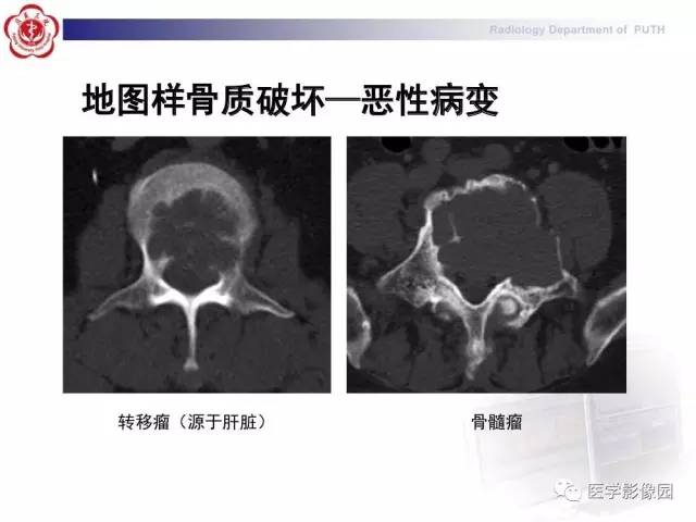 【PPT】脊柱肿瘤影像诊断思路