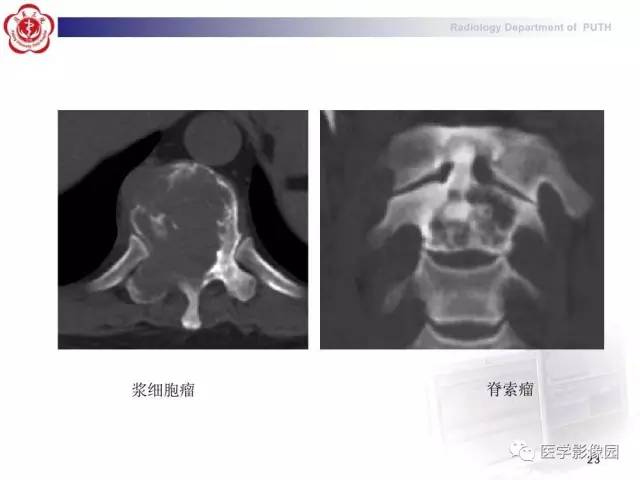 【PPT】脊柱肿瘤影像诊断思路
