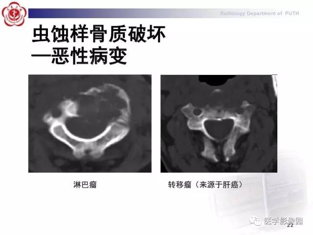 【PPT】脊柱肿瘤影像诊断思路