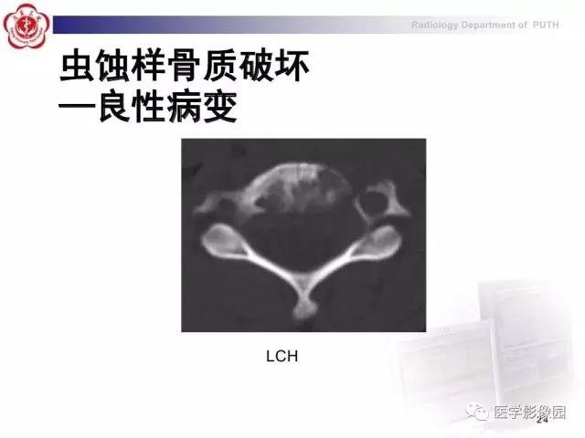 【PPT】脊柱肿瘤影像诊断思路