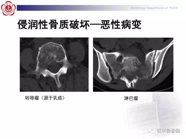 【PPT】脊柱肿瘤影像诊断思路