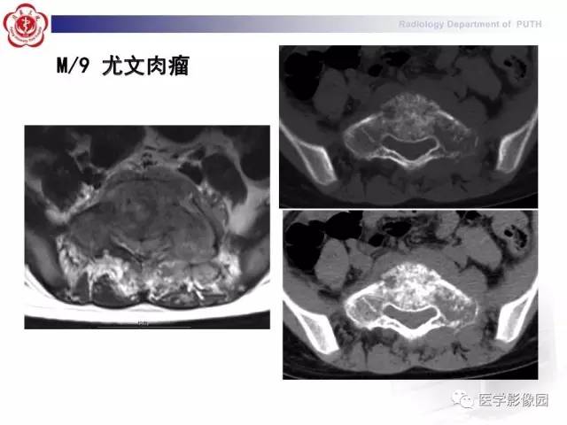 【PPT】脊柱肿瘤影像诊断思路