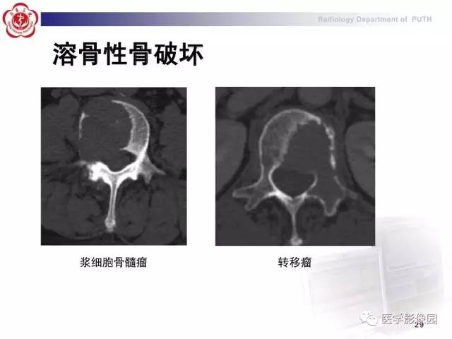 【PPT】脊柱肿瘤影像诊断思路