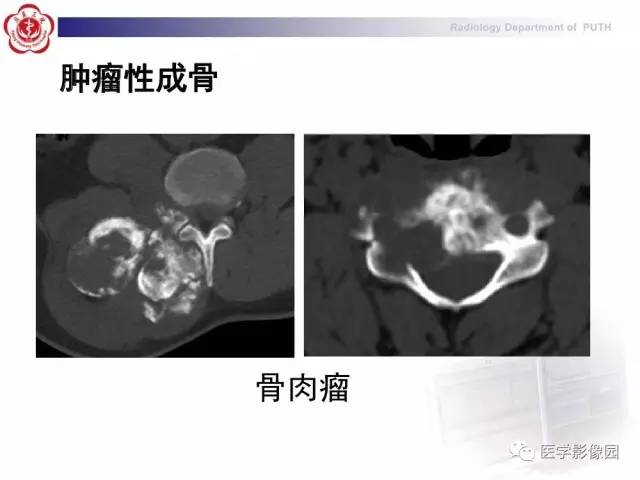 【PPT】脊柱肿瘤影像诊断思路