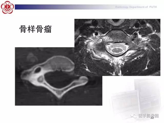 【PPT】脊柱肿瘤影像诊断思路