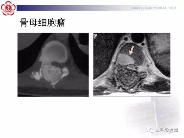 【PPT】脊柱肿瘤影像诊断思路