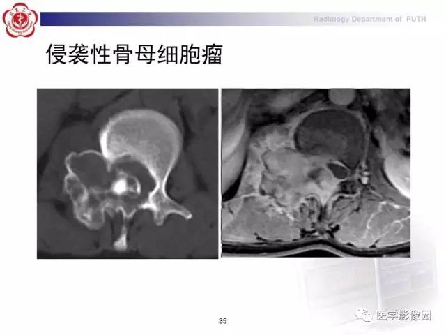 【PPT】脊柱肿瘤影像诊断思路