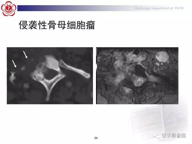 【PPT】脊柱肿瘤影像诊断思路