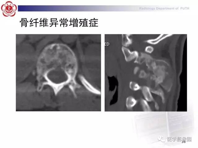 【PPT】脊柱肿瘤影像诊断思路