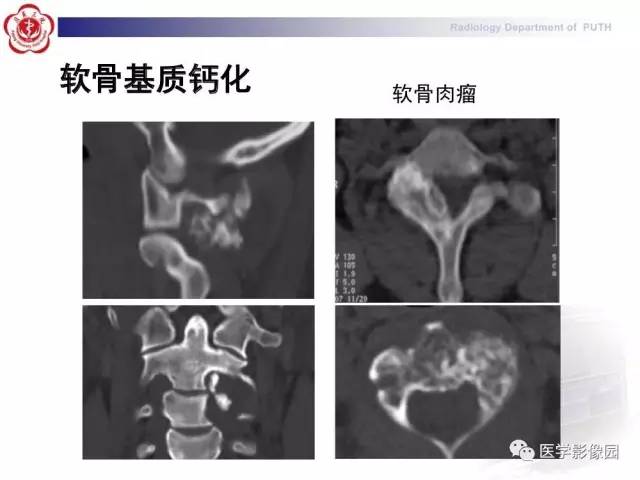 【PPT】脊柱肿瘤影像诊断思路