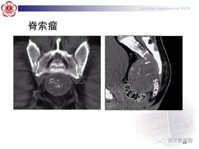 【PPT】脊柱肿瘤影像诊断思路