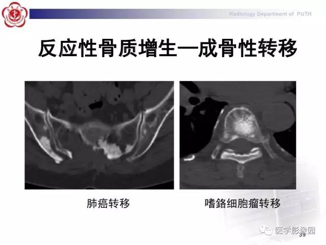 【PPT】脊柱肿瘤影像诊断思路