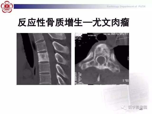 【PPT】脊柱肿瘤影像诊断思路