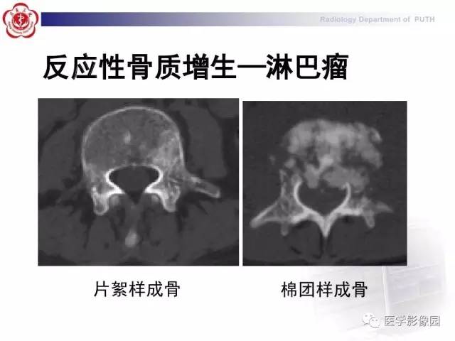 【PPT】脊柱肿瘤影像诊断思路