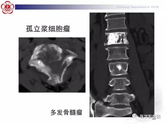 【PPT】脊柱肿瘤影像诊断思路