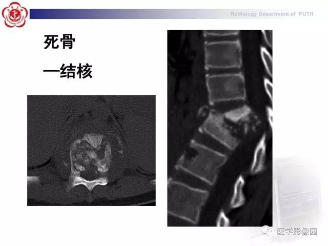 【PPT】脊柱肿瘤影像诊断思路