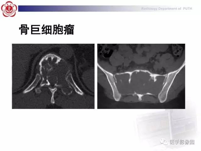 【PPT】脊柱肿瘤影像诊断思路