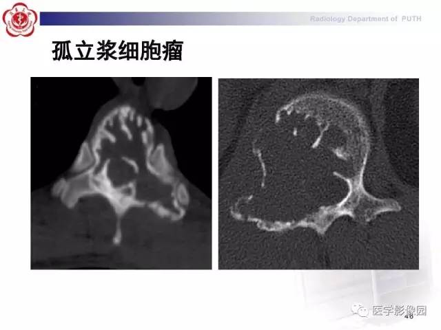 【PPT】脊柱肿瘤影像诊断思路