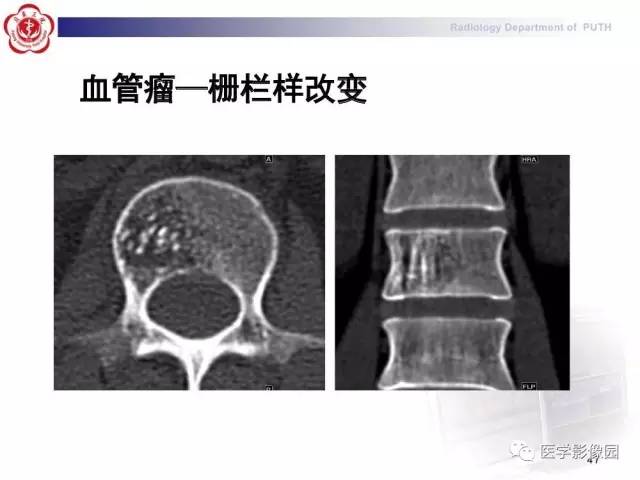 【PPT】脊柱肿瘤影像诊断思路