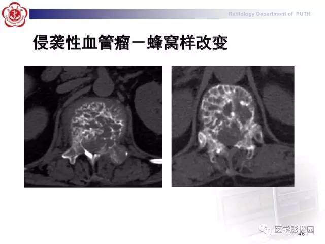 【PPT】脊柱肿瘤影像诊断思路