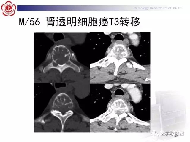 【PPT】脊柱肿瘤影像诊断思路
