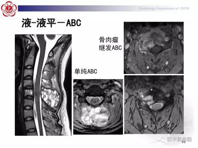 【PPT】脊柱肿瘤影像诊断思路
