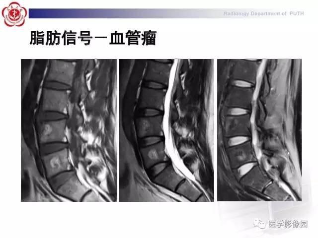【PPT】脊柱肿瘤影像诊断思路
