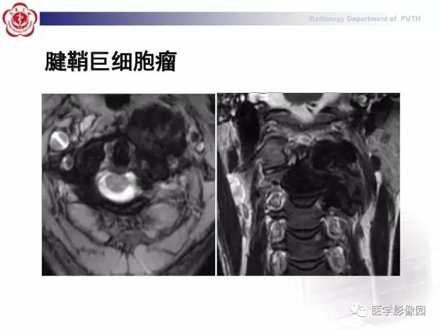 【PPT】脊柱肿瘤影像诊断思路