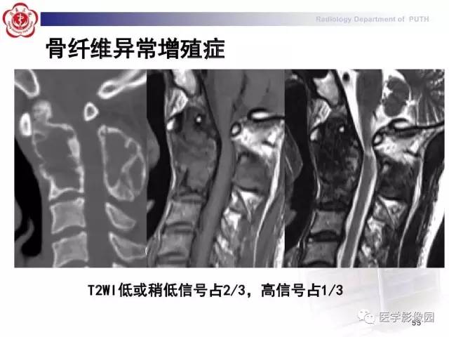【PPT】脊柱肿瘤影像诊断思路