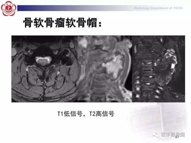 【PPT】脊柱肿瘤影像诊断思路