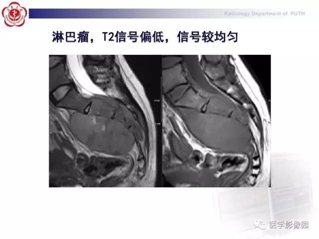 【PPT】脊柱肿瘤影像诊断思路