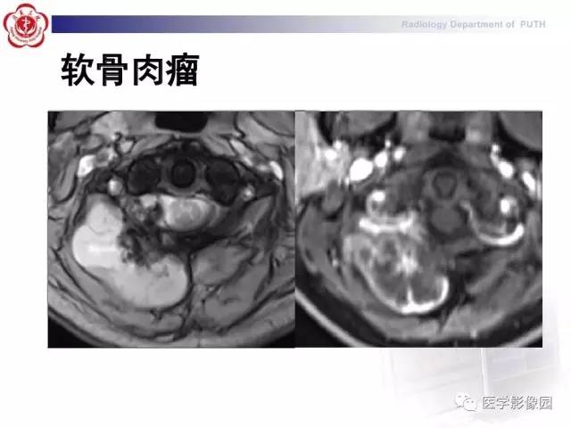 【PPT】脊柱肿瘤影像诊断思路