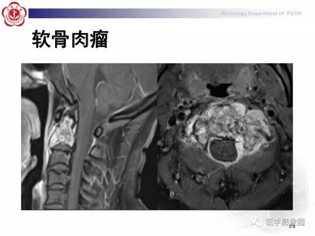 【PPT】脊柱肿瘤影像诊断思路
