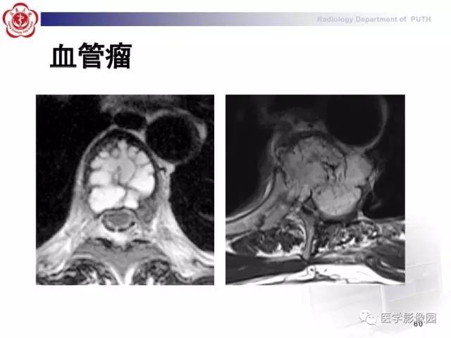【PPT】脊柱肿瘤影像诊断思路
