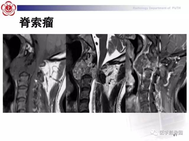 【PPT】脊柱肿瘤影像诊断思路