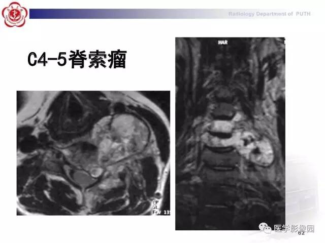 【PPT】脊柱肿瘤影像诊断思路