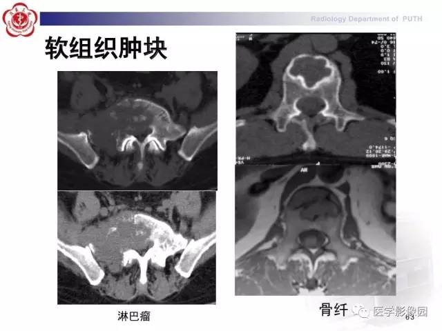 【PPT】脊柱肿瘤影像诊断思路