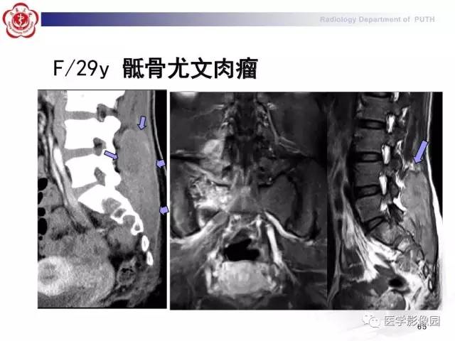【PPT】脊柱肿瘤影像诊断思路