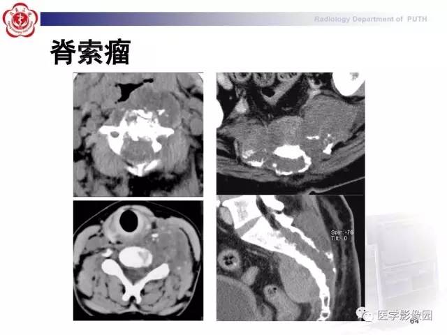 【PPT】脊柱肿瘤影像诊断思路