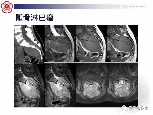 【PPT】脊柱肿瘤影像诊断思路